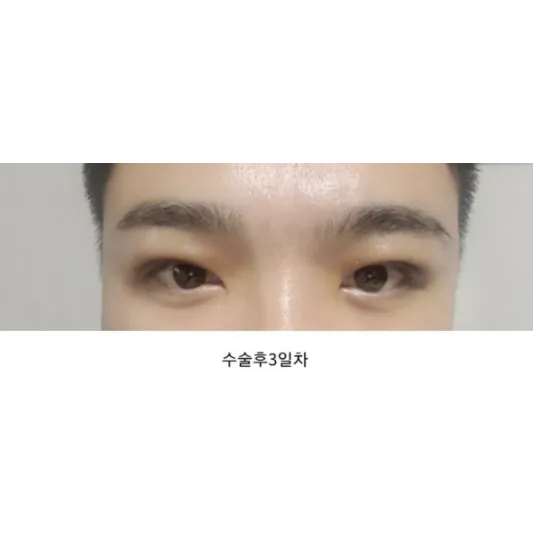 Incisional Double Eyelid Surgery, Ptosis Correction — Afternoon Plastic Surgery 3