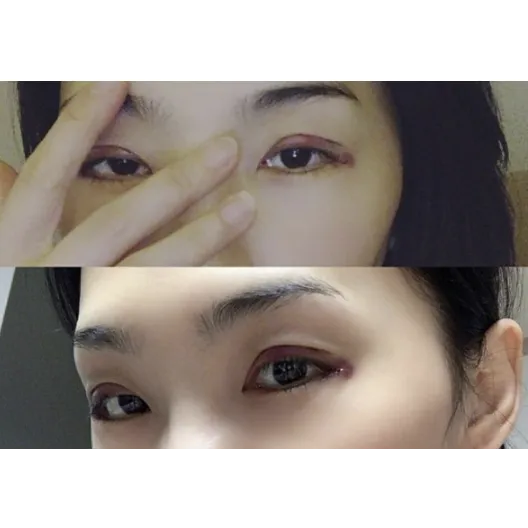 Ptosis Correction, Incisional Double Eyelid Surgery — Afternoon Plastic Surgery 2