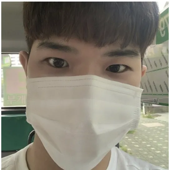 Ptosis Correction, Non-incisional double eyelid surgery 2
