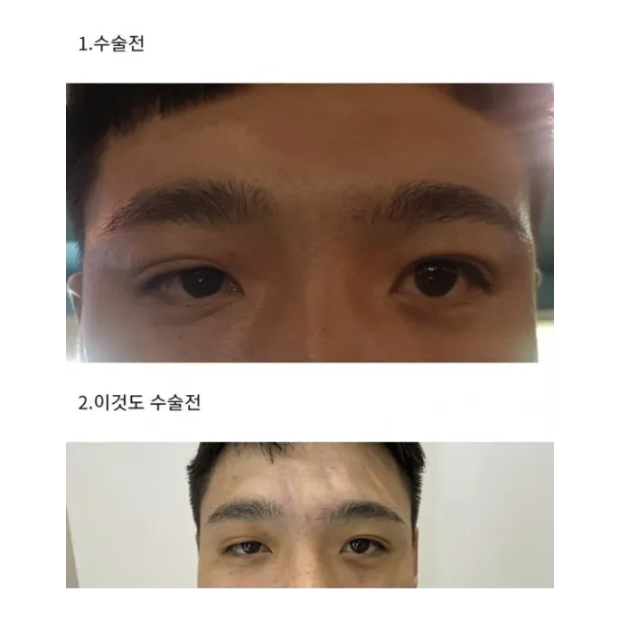 Ptosis Correction 1