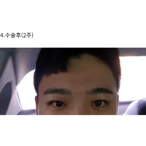 Ptosis Correction — Afternoon Plastic Surgery 2