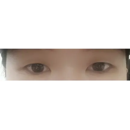 Incisional Double Eyelid Surgery 1