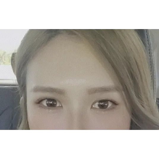 Incisional Double Eyelid Surgery, Ptosis Correction — Afternoon Plastic Surgery 2