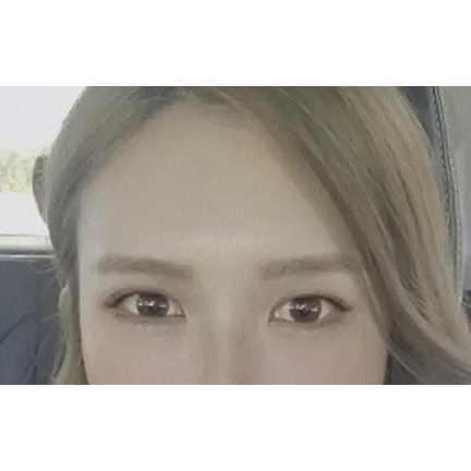 Incisional Double Eyelid Surgery 2