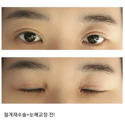 Revision ptosis correction 1