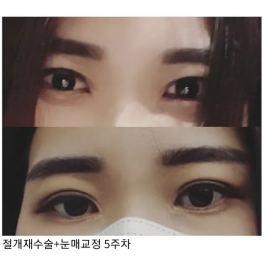 Revision ptosis correction — Afternoon Plastic Surgery 2