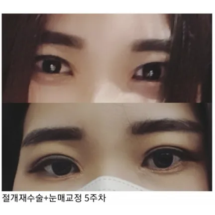 Revision ptosis correction 2