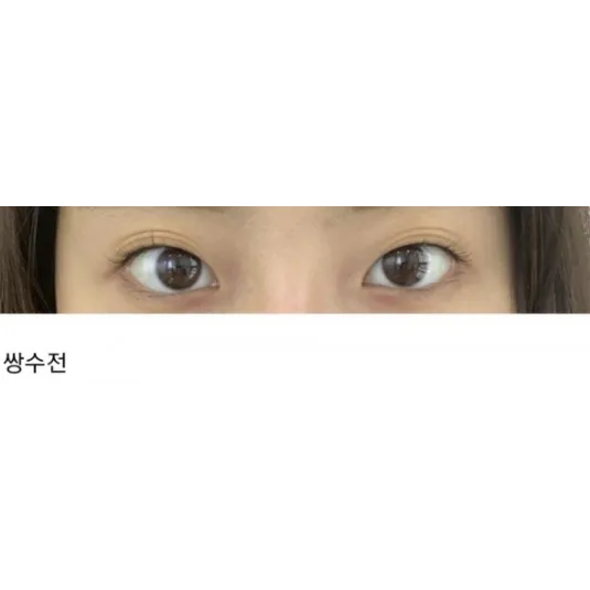 上睑下垂, 埋线 — Afternoon Plastic Surgery 1