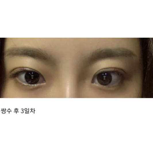 Ptosis Correction, Non-incisional double eyelid surgery 2