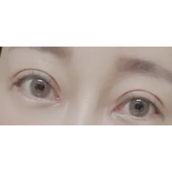 Revision ptosis correction — Afternoon Plastic Surgery 2