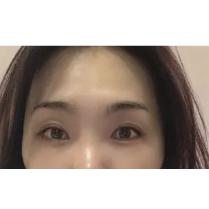 Incisional Double Eyelid Surgery — Afternoon Plastic Surgery 2