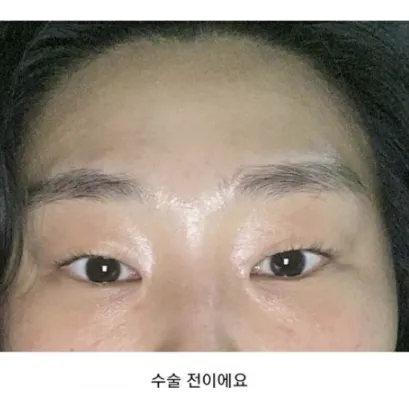 Incisional Double Eyelid Surgery, Ptosis Correction, Lateral canthoplasty 1
