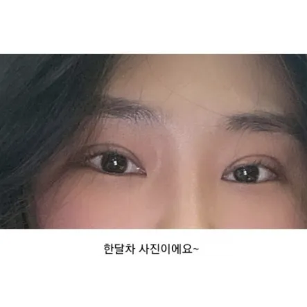 Incisional Double Eyelid Surgery, Ptosis Correction, Lateral canthoplasty — Afternoon Plastic Surgery 3
