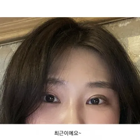 Incisional Double Eyelid Surgery, Ptosis Correction, Lateral canthoplasty — Afternoon Plastic Surgery 4