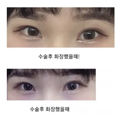 Revision ptosis correction — Afternoon Plastic Surgery 2