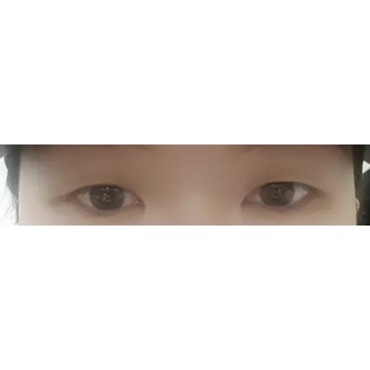 Incisional Double Eyelid Surgery, Ptosis Correction — Afternoon Plastic Surgery 1