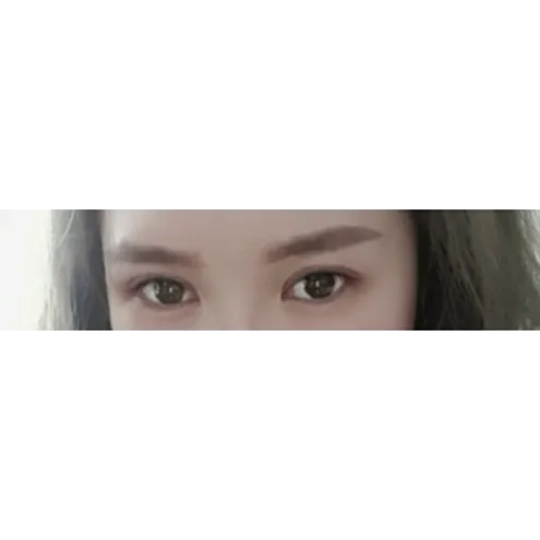 Incisional Double Eyelid Surgery, Ptosis Correction — Afternoon Plastic Surgery 2