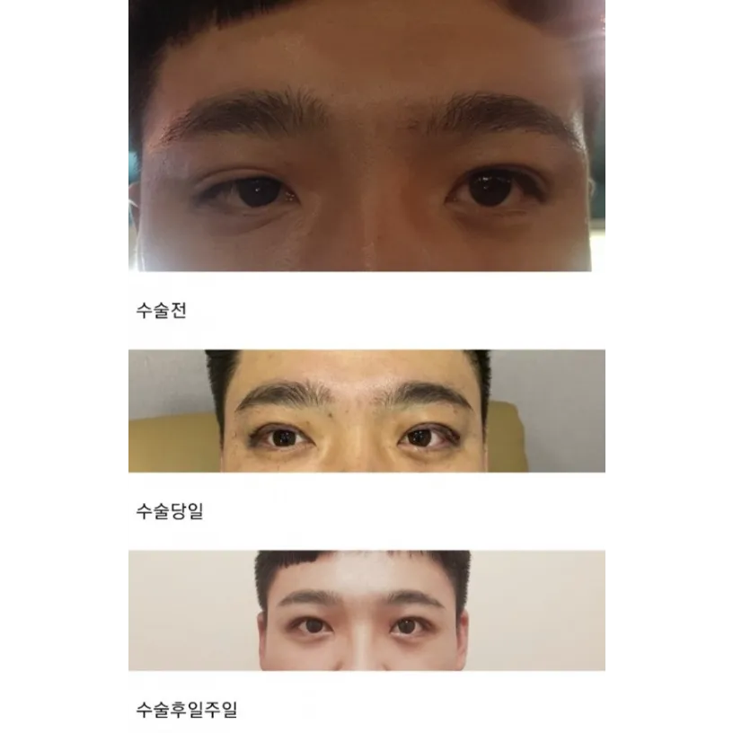 Ptosis Correction — Afternoon Plastic Surgery 1