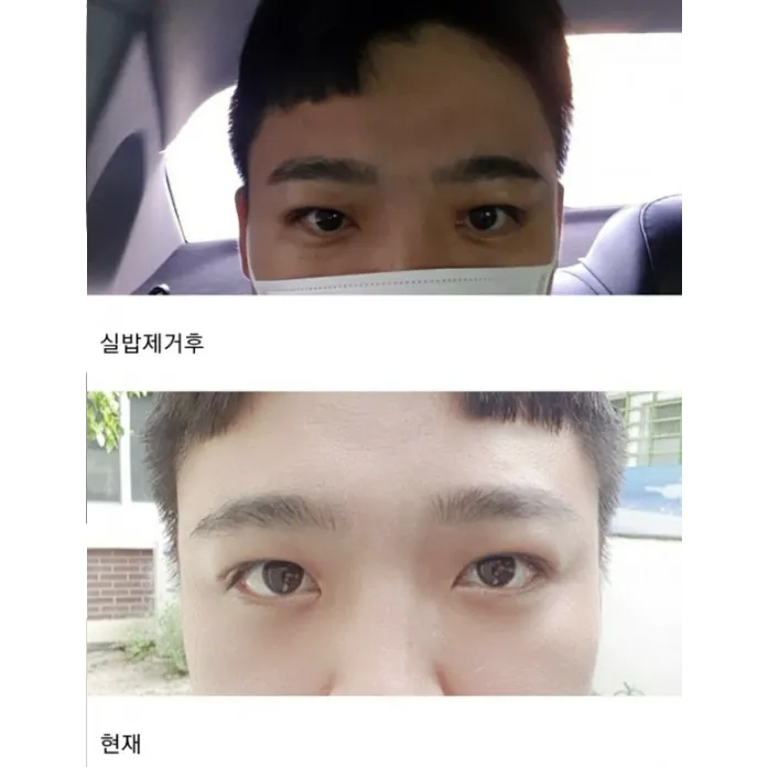 Ptosis Correction — Afternoon Plastic Surgery 2
