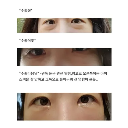 Lower Eyelid Fat Repositioning 1