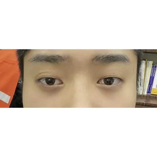 Incisional Double Eyelid Surgery, Ptosis Correction — Afternoon Plastic Surgery 1