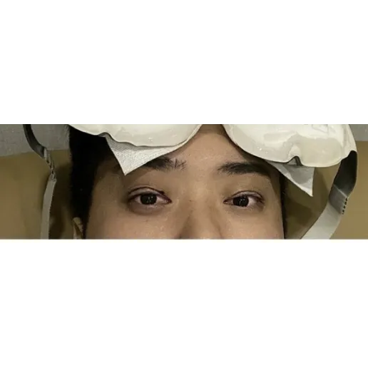 Incisional Double Eyelid Surgery, Ptosis Correction — Afternoon Plastic Surgery 2