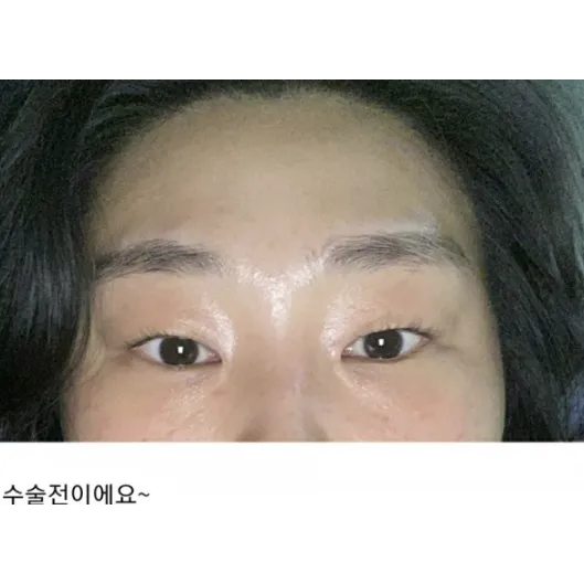 Ptosis Correction, Incisional Double Eyelid Surgery 1