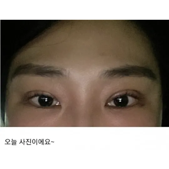 Ptosis Correction, Incisional Double Eyelid Surgery — Afternoon Plastic Surgery 3