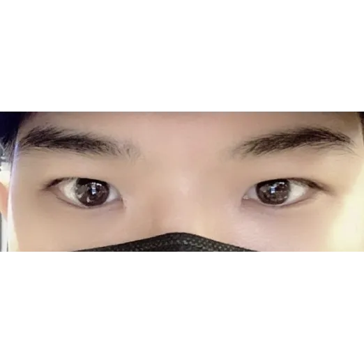 Ptosis Correction, Incisional Double Eyelid Surgery — Afternoon Plastic Surgery 2
