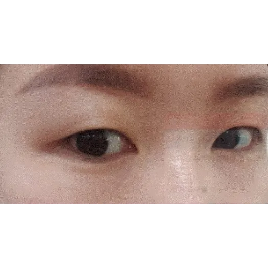 Revision ptosis correction 1