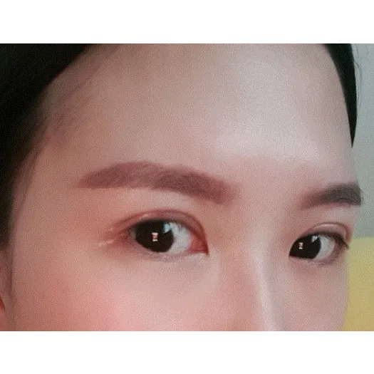 Revision ptosis correction 2