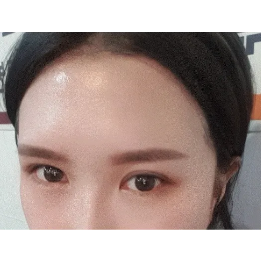 Revision ptosis correction — Afternoon Plastic Surgery 3