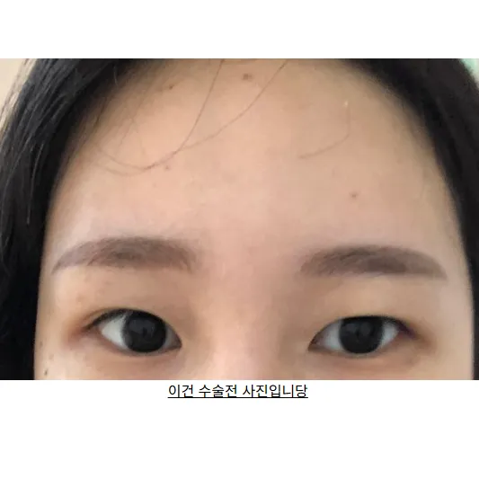 Incisional Double Eyelid Surgery — Afternoon Plastic Surgery 2