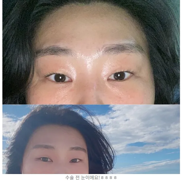 Lateral canthoplasty, Incisional Double Eyelid Surgery 1