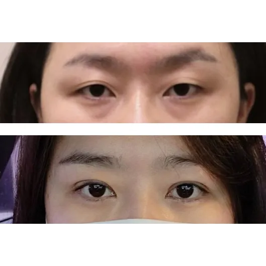 Ptosis Correction — Afternoon Plastic Surgery 1