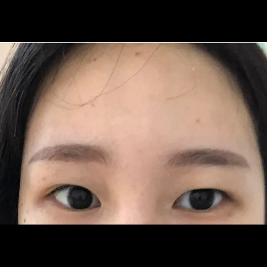 Incisional Double Eyelid Surgery — Afternoon Plastic Surgery 2