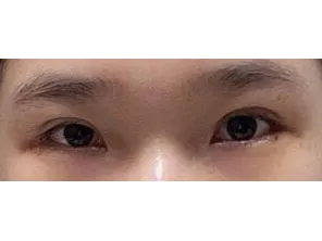 Lateral canthoplasty 1