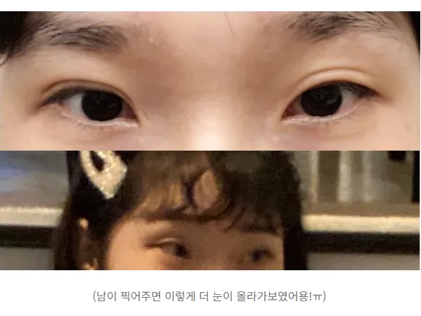 Lateral canthoplasty 2