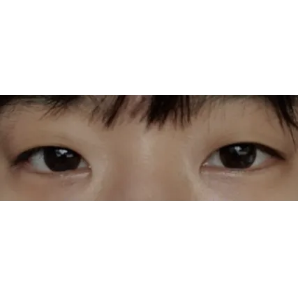 Incisional Double Eyelid Surgery, Epicanthoplasty, Ptosis Correction 1
