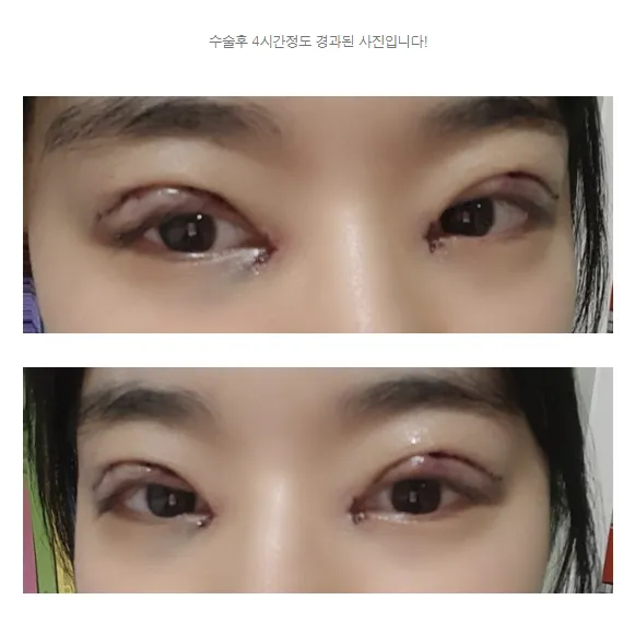 Incisional Double Eyelid Surgery, Epicanthoplasty, Ptosis Correction — Afternoon Plastic Surgery 2