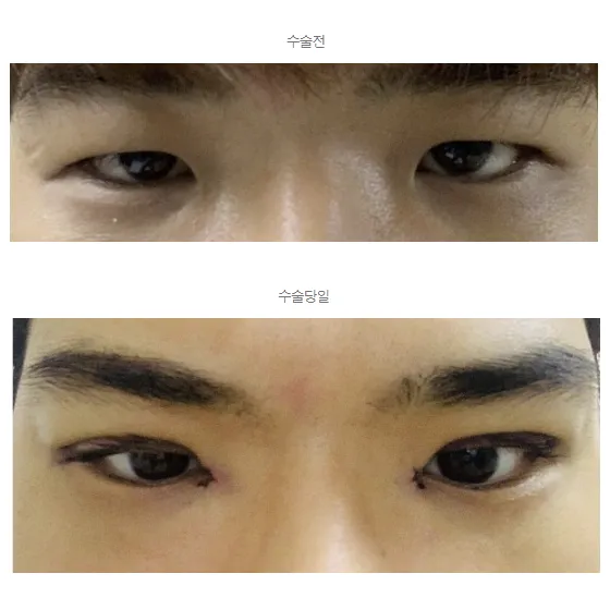 Epicanthoplasty 1