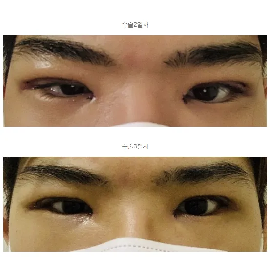 Epicanthoplasty 2