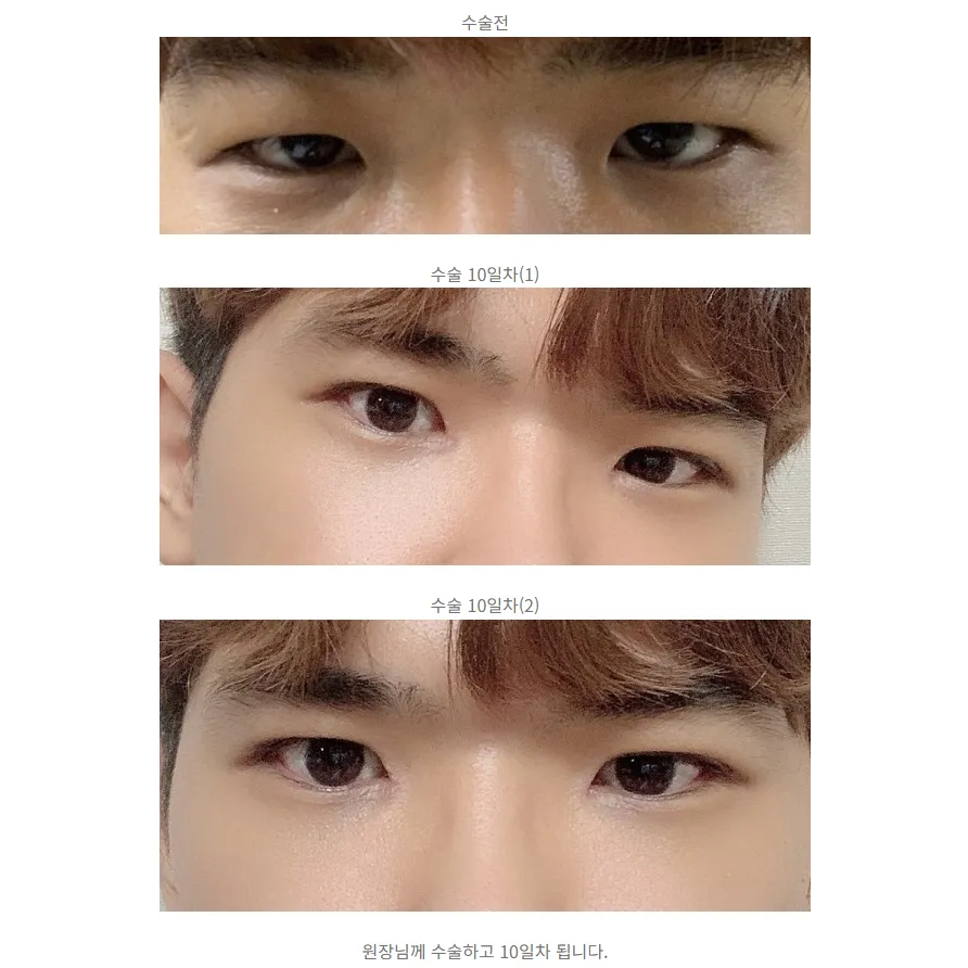 Ptosis Correction — Afternoon Plastic Surgery 1