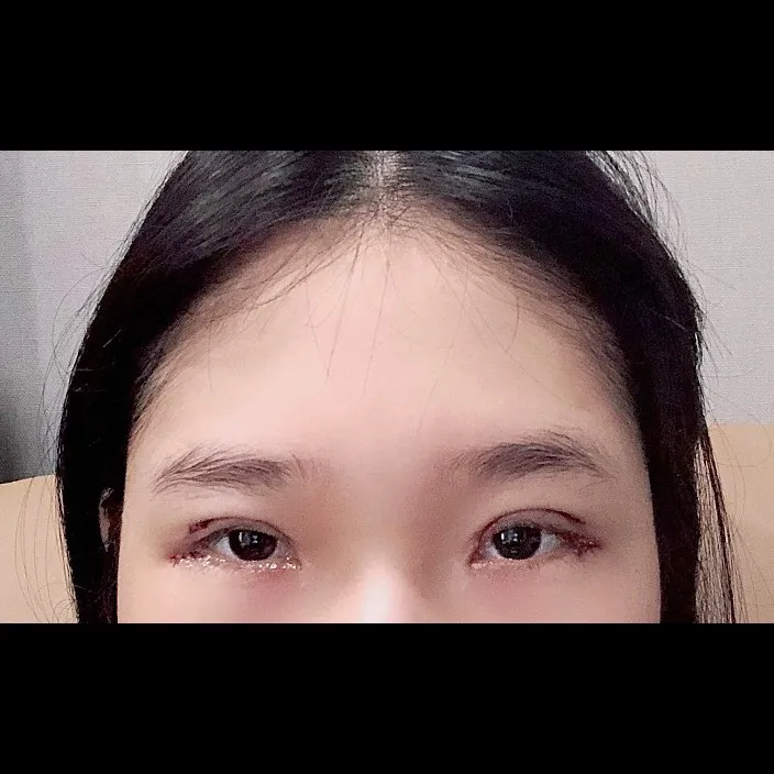 Incisional Double Eyelid Surgery, Lateral canthoplasty 1