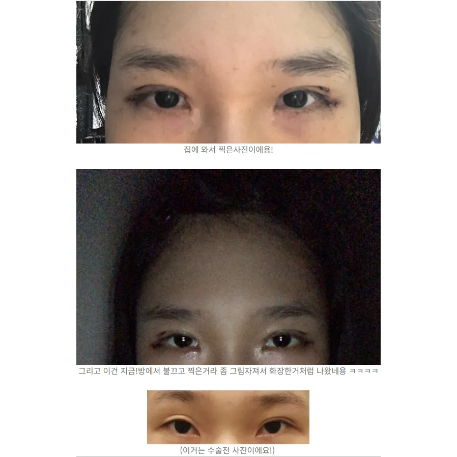 Incisional Double Eyelid Surgery, Lateral canthoplasty 2