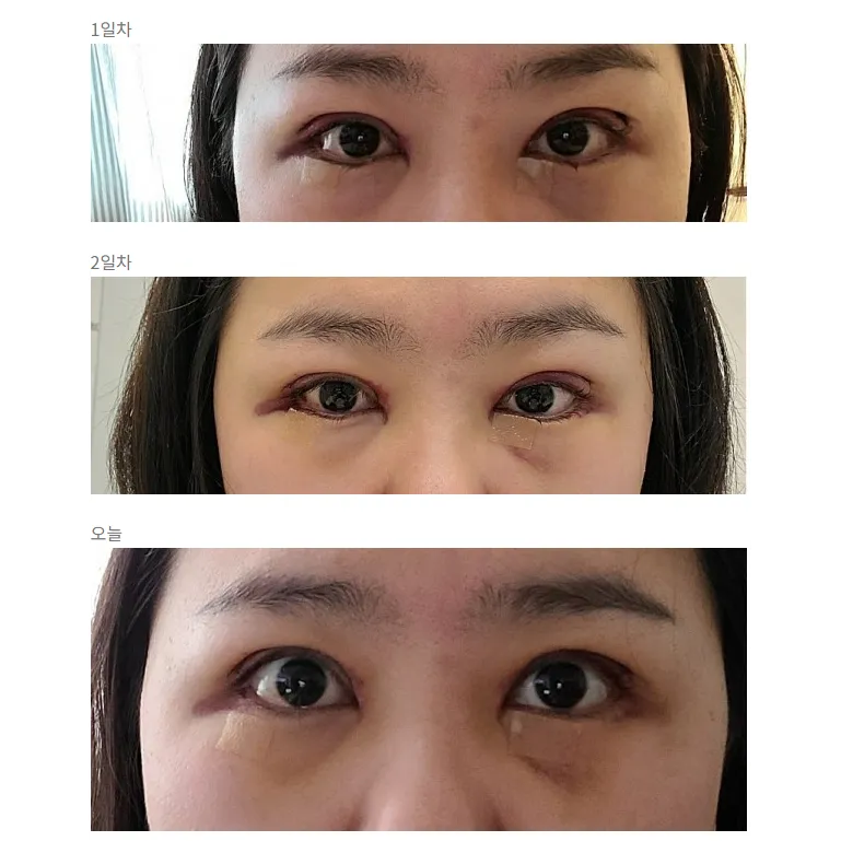 Incisional Double Eyelid Surgery — Afternoon Plastic Surgery 2