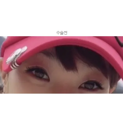 Revision ptosis correction, Lateral canthoplasty, Epicanthoplasty 1