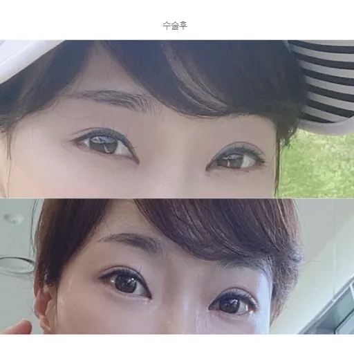 Revision ptosis correction, Lateral canthoplasty, Epicanthoplasty 2