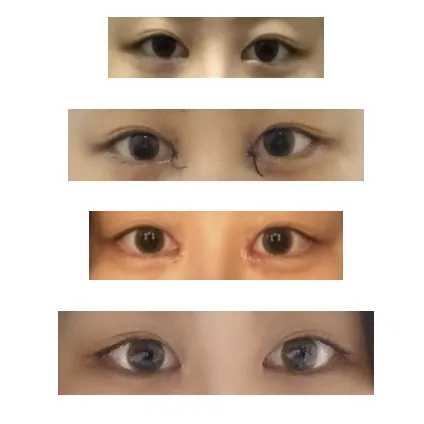 Epicanthoplasty Revision (Reconstruction) 1