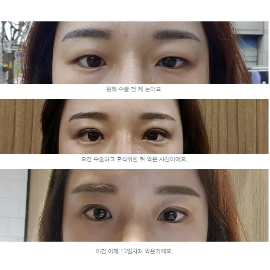 Ptosis Correction — Afternoon Plastic Surgery 1